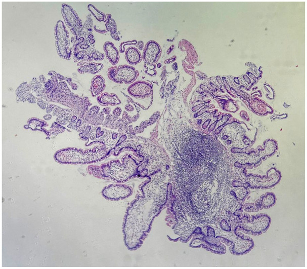 Protein-losing enteropathy as initial presentation of pediatric systemic lupus erythematosus: A rare case report from Vietnam and literature review.