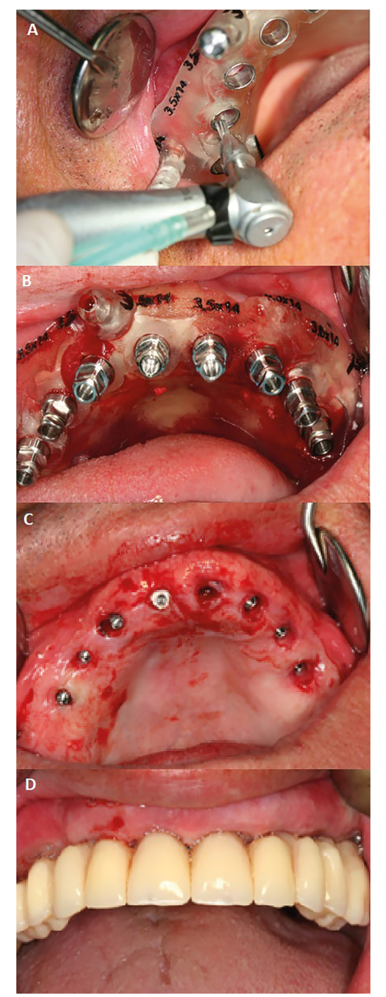Retrospective clinical follow-up of implants placed in edentulous jaws after computer-guided surgery and immediate loading, in geriatric patients.