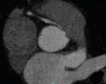 Anomalous Right Coronary Artery: Culprit or Innocent Bystander?