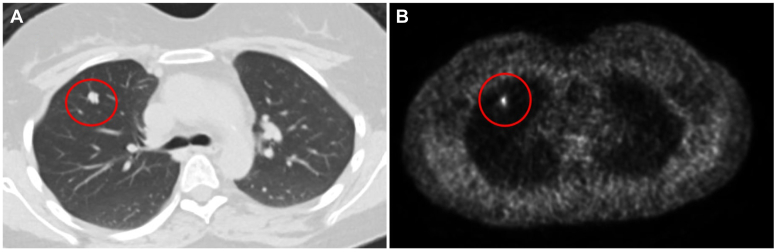 Finding the Culprit: Cushing Syndrome Secondary to Lung Carcinoid Tumor