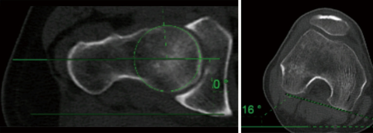Radiological assessment of lower limb torsional deformities: a narrative review.
