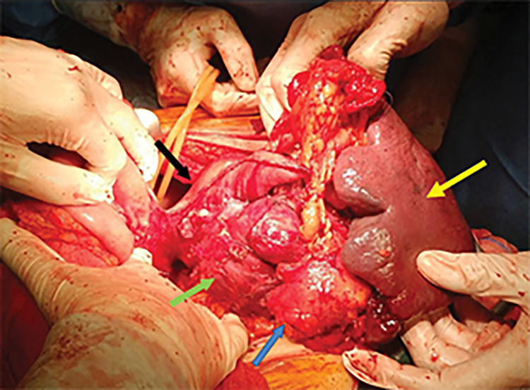 A Large Gastrointestinal Stromal Tumor under the Disguise of a Gastric Diverticulum: Report of a Case and Review of the Literature.