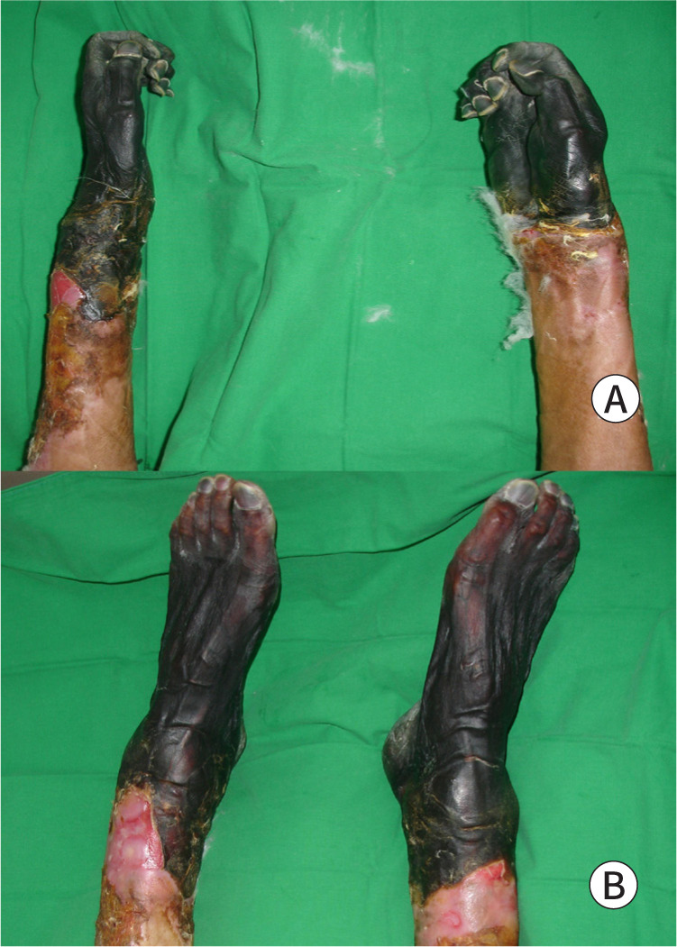Determining the timing and extent of amputation in symmetrical peripheral gangrene: a report of three cases from Korea.