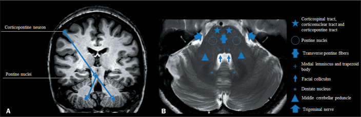 Hyperintense lesions of the middle cerebellar peduncle and beyond: a pictorial essay.