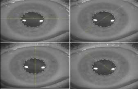 Assessing the Relationship between Graft-Host Junction Profile and Corneal Astigmatism and Higher-Order Aberrations in Postpenetrating Keratoplasty Eyes.