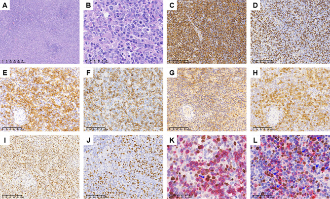 An exploratory study on the differential diagnostic indicators between adult systemic EBV-positive T-cell lymphoproliferative disorders and angioimmunoblastic T-cell lymphoma with multiple EBV infections.