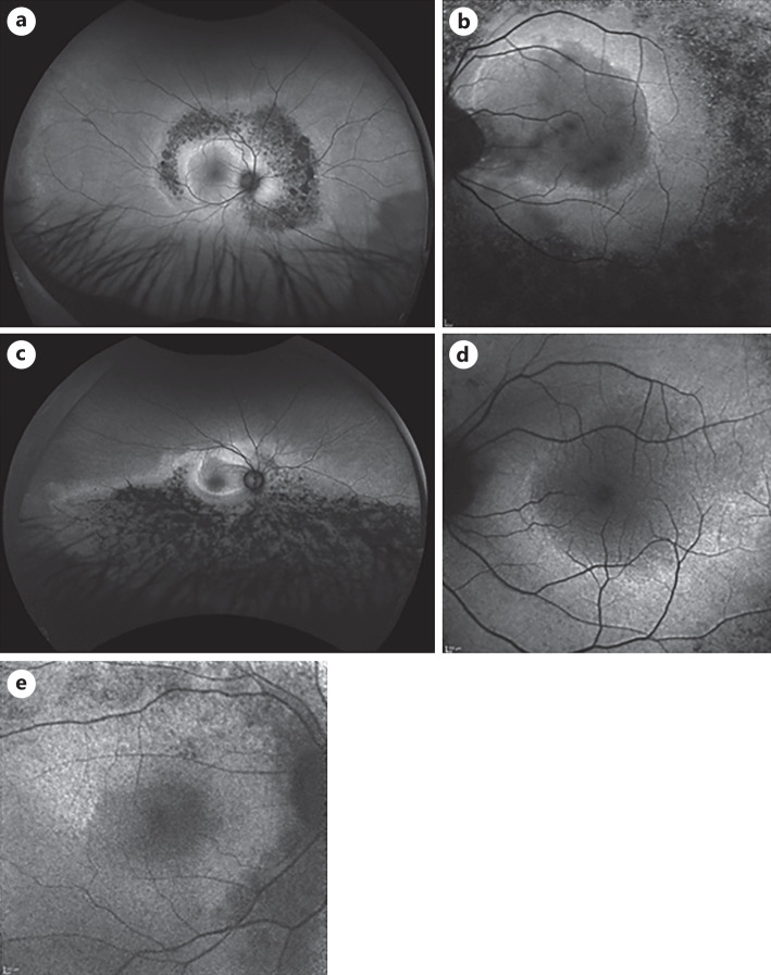 Characterization of Macular Fundus Autofluorescence Changes in Patients with Retinitis Pigmentosa.