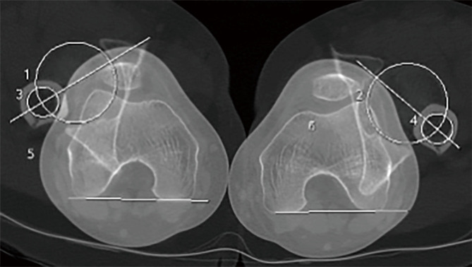 Radiological assessment of lower limb torsional deformities: a narrative review.