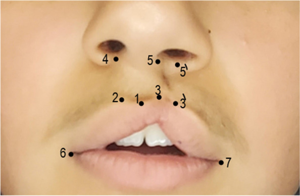 Treatment outcomes of two surgical techniques in secondary reconstruction of unilateral cleft lip and ala nasi utilizing anthropometry assessment: a randomized controlled trial.