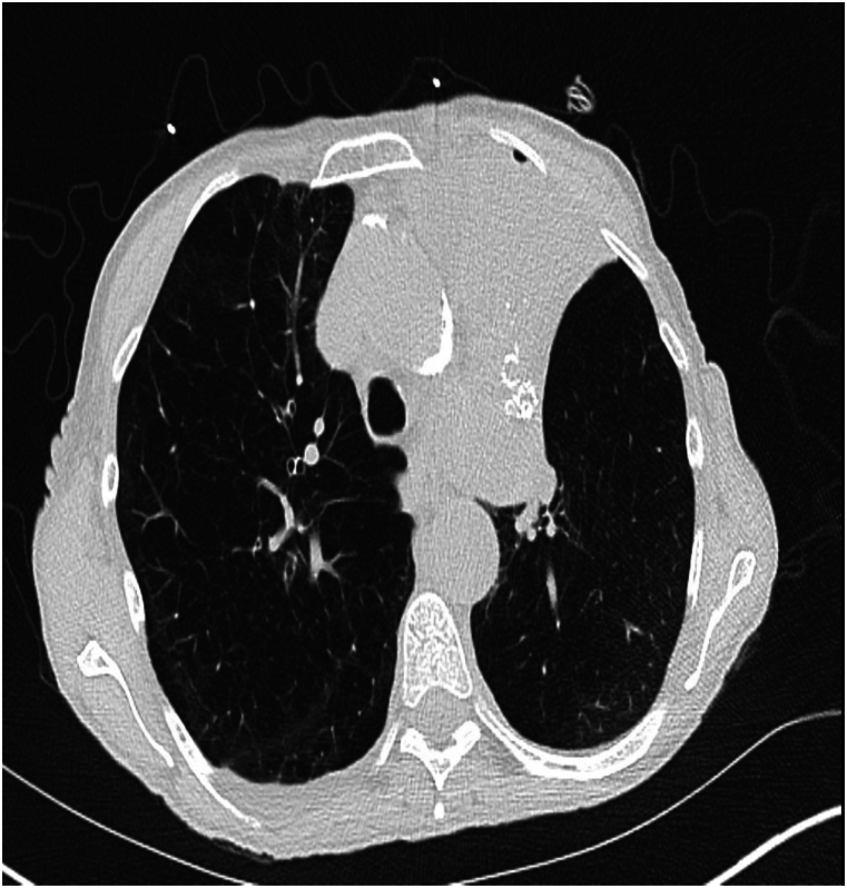 Bronchoscopic lung volume reduction complicated by ipsilateral pleural effusion
