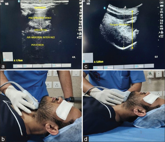 Evaluation of ultrasound measured tongue thickness, tongue thickness-thyromental distance ratio, and skin-to-epiglottis distance in predicting unanticipated difficult laryngoscopy.
