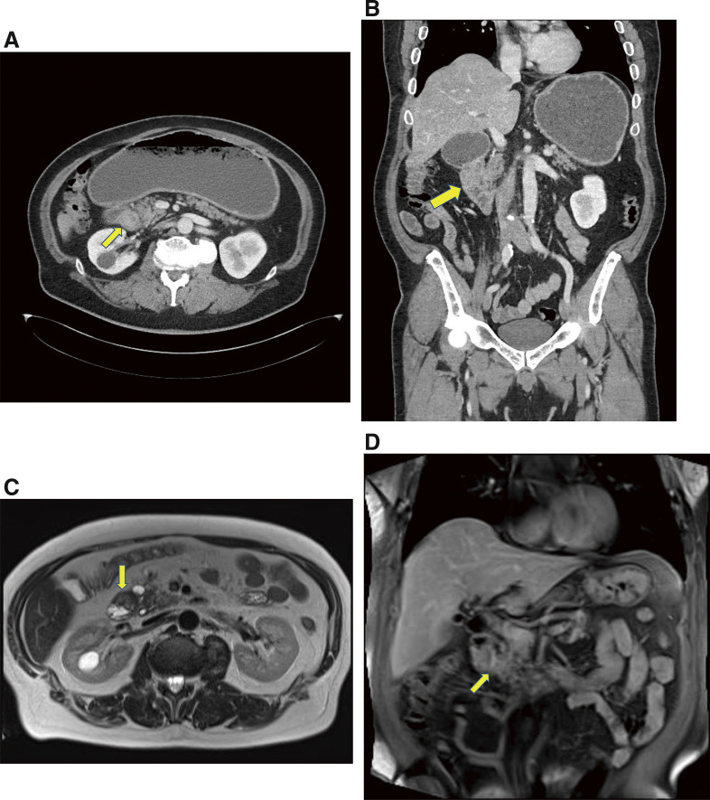 A Rare Case of Ampullary Carcinoma with Complete Duodenal Obstruction as the Initial Manifestation.