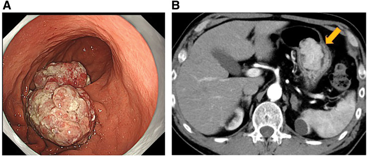 Gastroduodenal Intussusception with Gastric Adenocarcinoma: A Case Report and Review of the Literature.