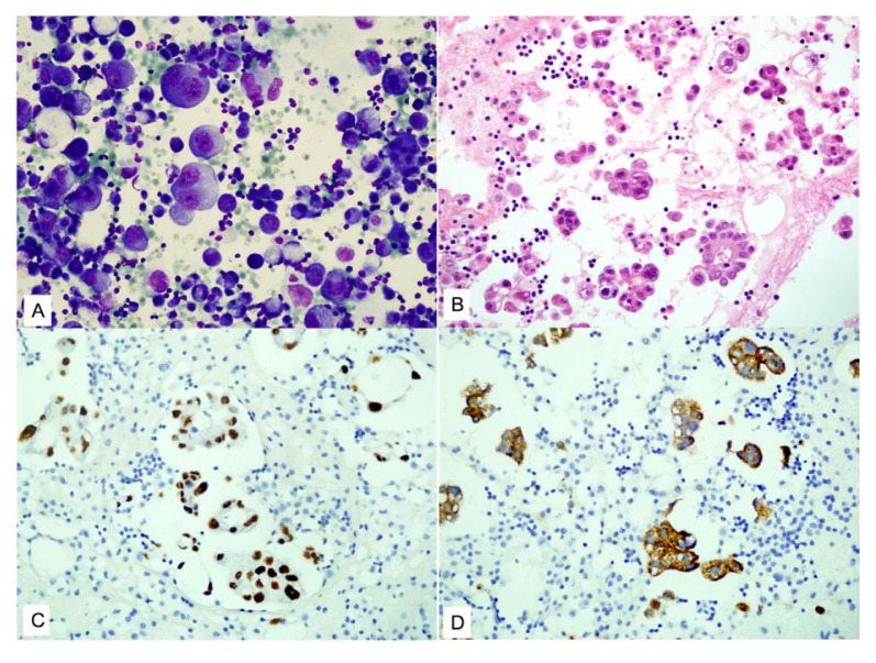 Cytopathological evaluation of pericardial effusions: 192 cases from a tertiary-level healthcare center.