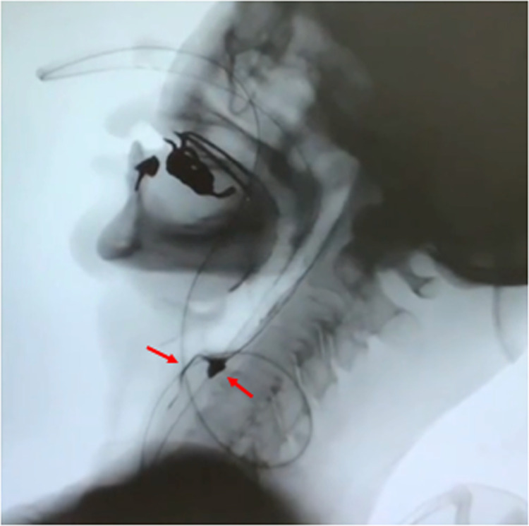 Refractory Severe Anti-SRP Myopathy that Improved with Long-term Rehabilitation Therapy: A Case Report.