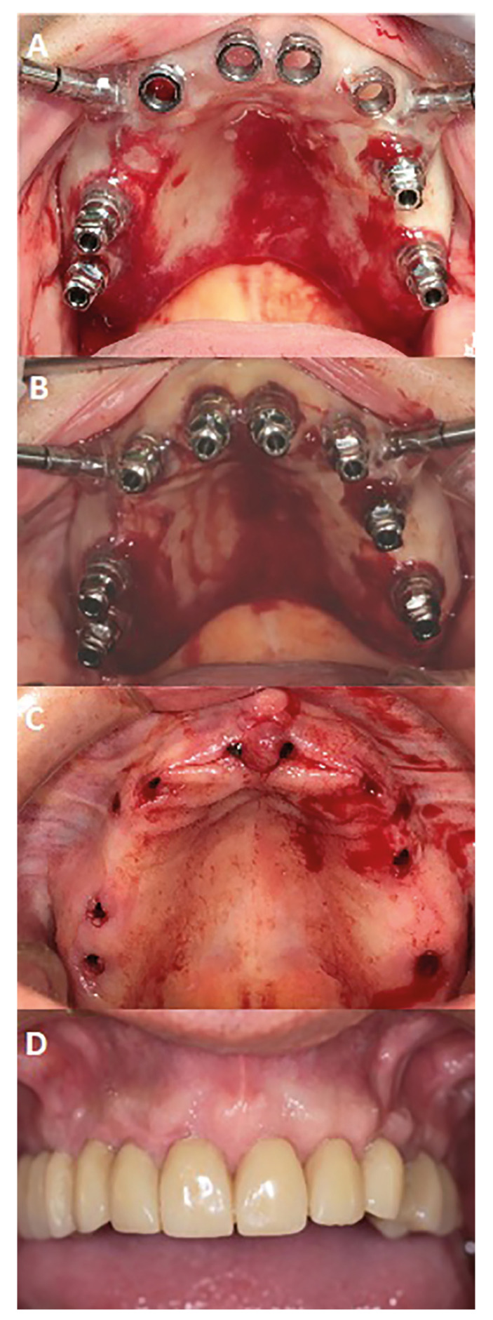 Retrospective clinical follow-up of implants placed in edentulous jaws after computer-guided surgery and immediate loading, in geriatric patients.