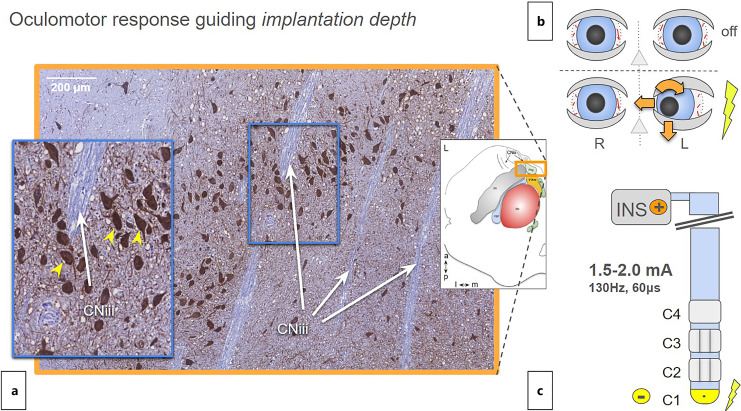 Joint Anatomical, Histological, and Imaging Investigation of the Midbrain Target Region for Superolateral Medial Forebrain Bundle Deep Brain Stimulation.