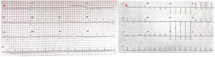 Polymyositis-Induced Atrial Flutter: A Rare and Unexpected Arrhythmia in an Idiopathic Inflammatory Myopathy.