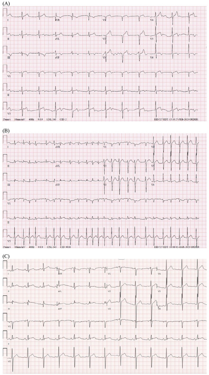 Streptococcal Pharyngitis Complicated by Clinically Significant Rheumatic Myopericarditis: A Case Report.