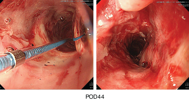 Late Graft Failure Due to Arterio-Venous Fistula in the Free Jejunal Graft Mesentery Following Total Pharyngo-Laryngo-Esophagectomy for Cervical Esophageal Cancer: A Case Report.