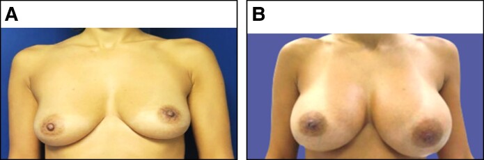 Galactocele Following Aesthetic Breast Augmentation: Diagnosis, Management, and Prevention.