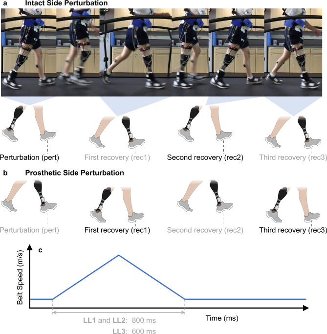 A sensory neuroprosthesis enhances recovery from treadmill-induced stumbles for individuals with lower limb loss.