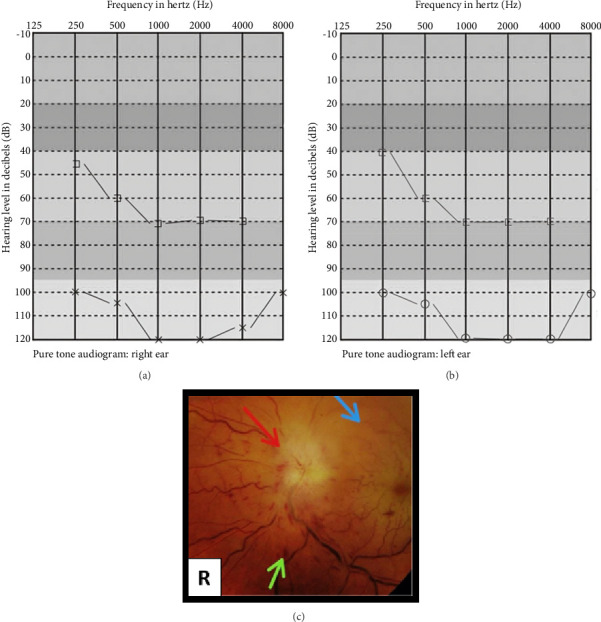 Chronic Myeloid Leukemia Presenting With Bilateral Optic Neuropathy and Sensorineural Hearing Loss as the First Clinical Presentation: A Case Report.