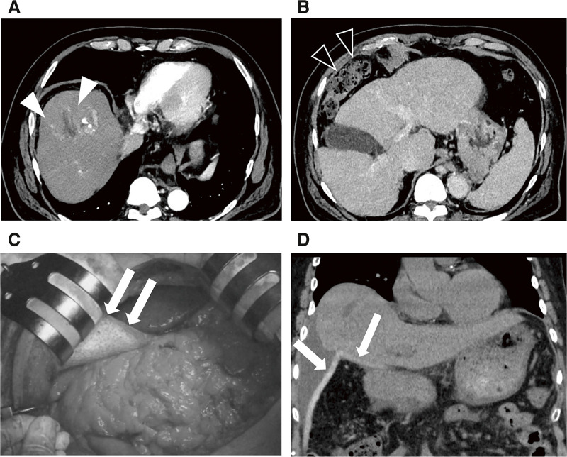 A Case of Unresectable Hepatocellular Carcinoma Treated with Spacer Placement Surgery with Bioabsorbable Spacer and Subsequent Proton Beam Therapy.