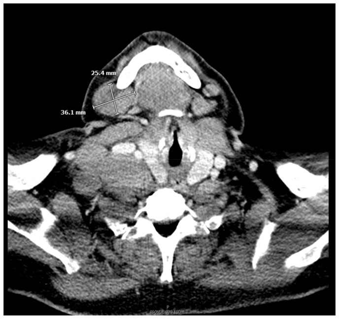 Marginal Zone Lymphoma in a Case of Hidradenitis Suppurativa Treated With Adalimumab Therapy.