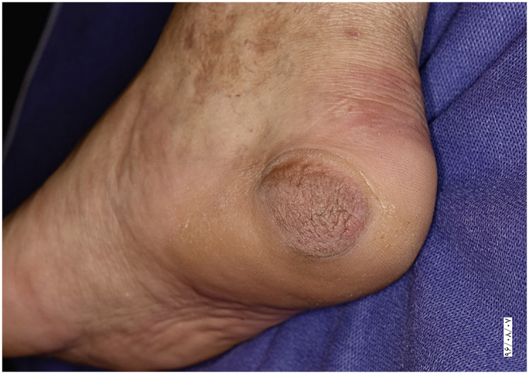 Verrucous Eccrine Angiomatous Hamartoma: A Case Report.