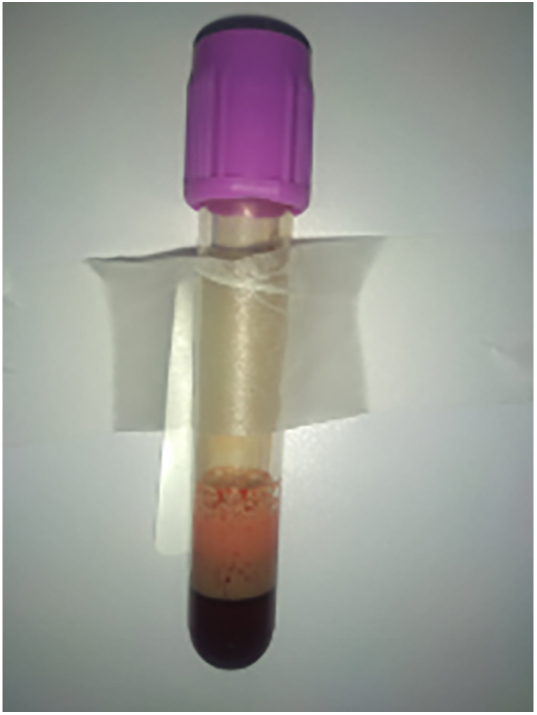 Rare presentation of vitamin D toxicity with hypertriglyceridemia and pancreatitis.