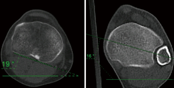 Radiological assessment of lower limb torsional deformities: a narrative review.