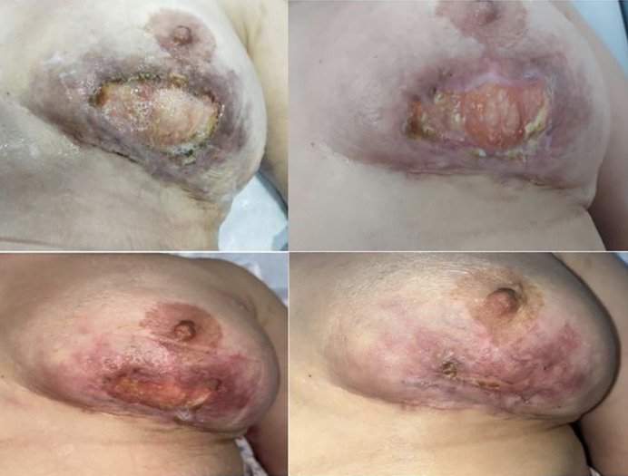 Pyoderma Gangrenosum: A Nightmare for Breast Surgery-Two Case Reports.