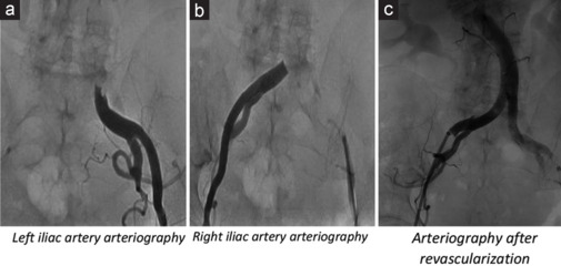 Stress Cardiomyopathy Complicated By Left Ventricular Thrombosis with Fatal Detachment.