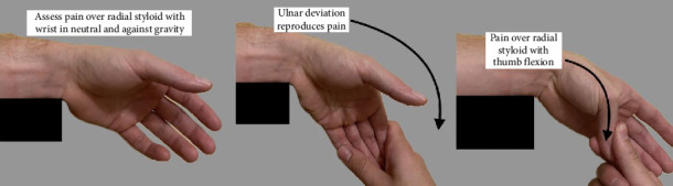De Quervain's Tenosynovitis Virally Exacerbated by SARS-CoV-2 and Influenza Infections: A Case Report.