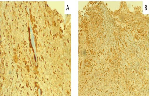 Laryngeal Frame Involvement as The First Sign of Wegener's Granulomatosis.