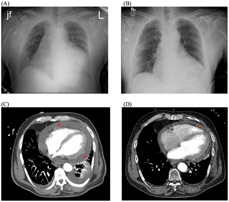 Streptococcal Pharyngitis Complicated by Clinically Significant Rheumatic Myopericarditis: A Case Report.