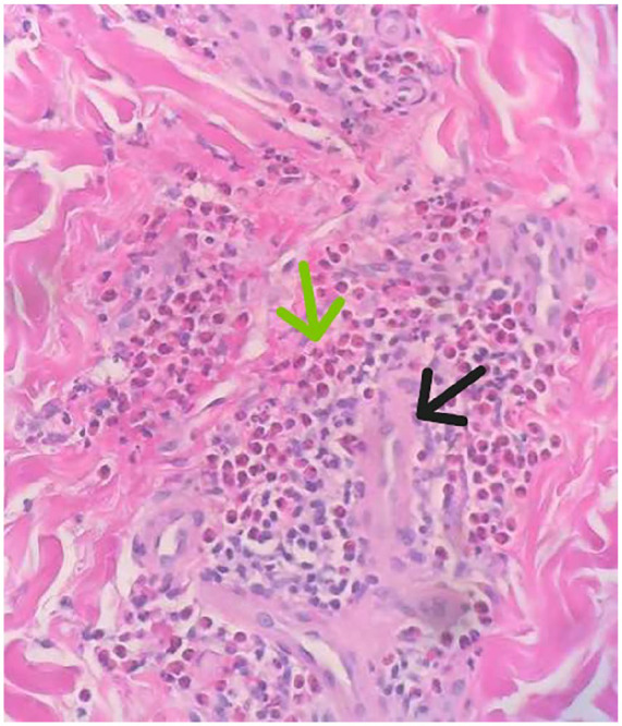 Idiopathic Secondary Eosinophilia: Revealing Cerebral Aneurysms as a Vascular Complication.