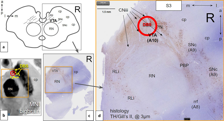 Joint Anatomical, Histological, and Imaging Investigation of the Midbrain Target Region for Superolateral Medial Forebrain Bundle Deep Brain Stimulation.