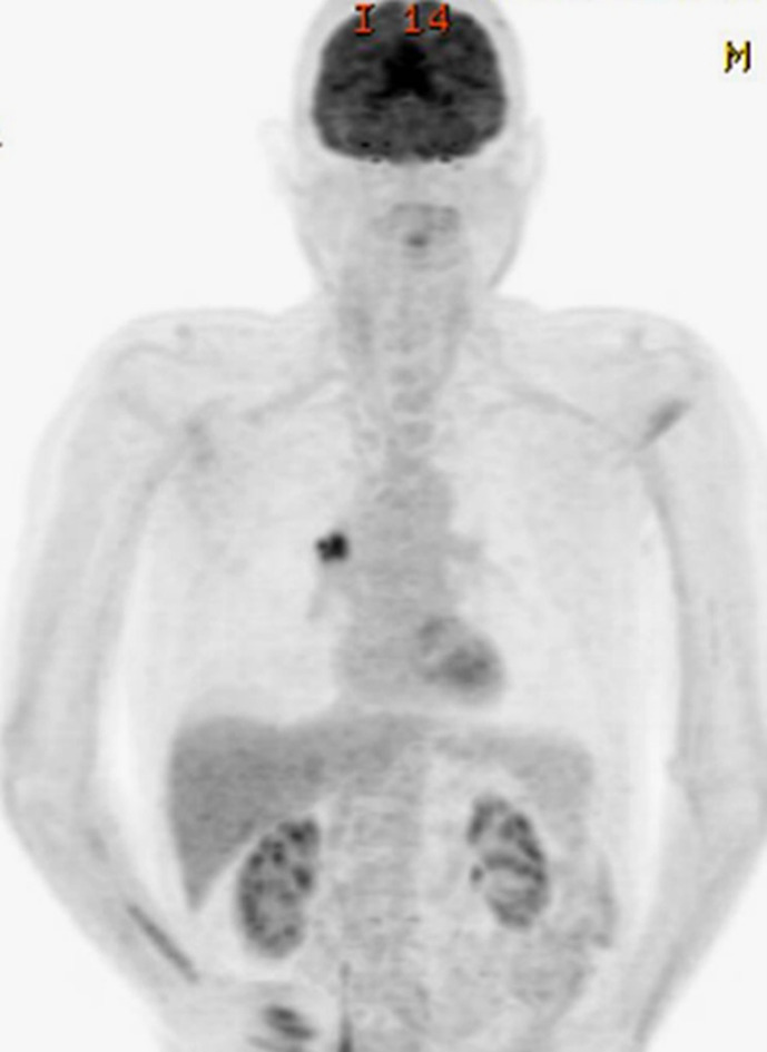 Bilateral Paraneoplastic Optic Neuropathy as the First Presentation of Preclinical Small Cell Lung Cancer: Case Report.