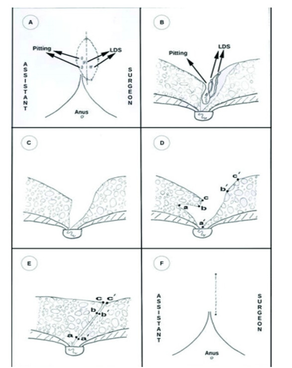 Karydakis Flap as a Simple Surgical Method in the Treatment of Pilonidal Disease V.S Open Surgery with Average 30-month-follow up: A Clinical Trial.