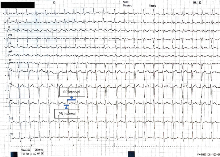 Decoding the Rhythm: The Additive Value of Left Atrial Appendage Flow in the Diagnosis of Atrial Tachyarrhythmias.
