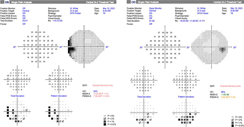 Bilateral Paraneoplastic Optic Neuropathy as the First Presentation of Preclinical Small Cell Lung Cancer: Case Report.
