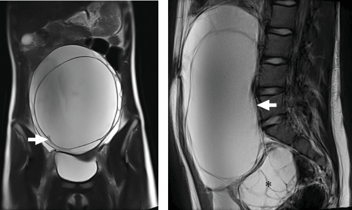 An Adolescent With a Giant Ovarian Cyst and Hyperandrogenism: Case Report.