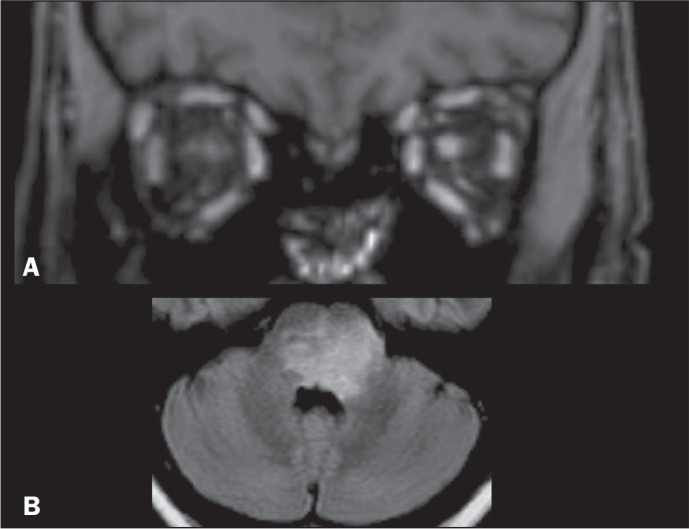Hyperintense lesions of the middle cerebellar peduncle and beyond: a pictorial essay.