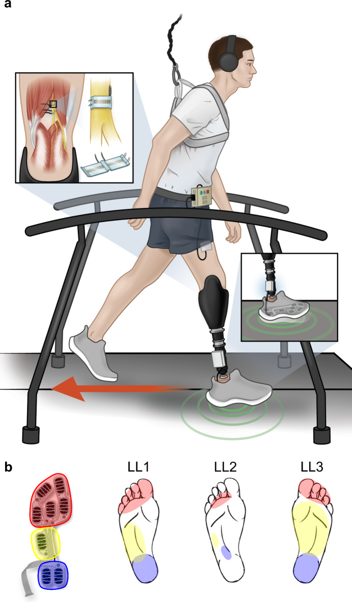 A sensory neuroprosthesis enhances recovery from treadmill-induced stumbles for individuals with lower limb loss.
