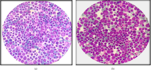 Chronic Myeloid Leukemia Presenting With Bilateral Optic Neuropathy and Sensorineural Hearing Loss as the First Clinical Presentation: A Case Report.