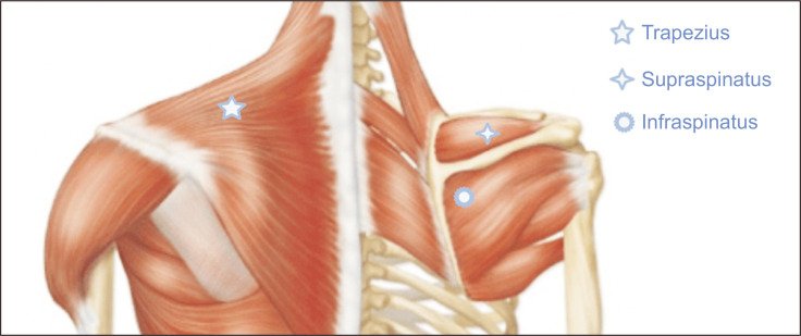 The impact of central sensitization-related symptoms on subacromial steroid injection outcomes in patients with subacromial impingement syndrome: an observational study.