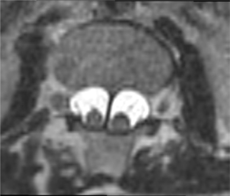 Split cord malformation - a simple, current classification based on CT and MRI neuroimaging studies.