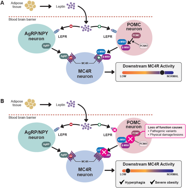 Defining Hyperphagia for Improved Diagnosis and Management of MC4R Pathway-Associated Disease: A Roundtable Summary.